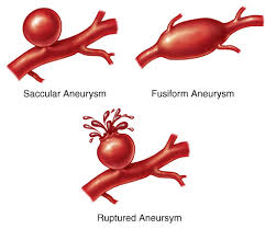tipos de aneurismas